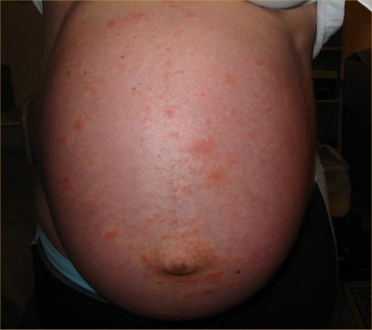 PUPPS Rash Postpartum: Causes and Effective Treatments