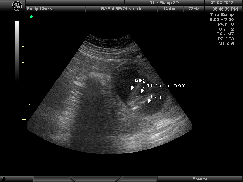 What To Expect In Ultrasound Done At 15 Weeks Pregnant New Kids